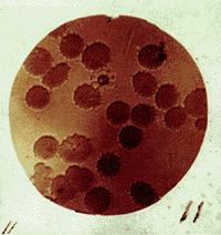 A typical rosette-shape of the malarian parasite on the top, among red blood cells.
