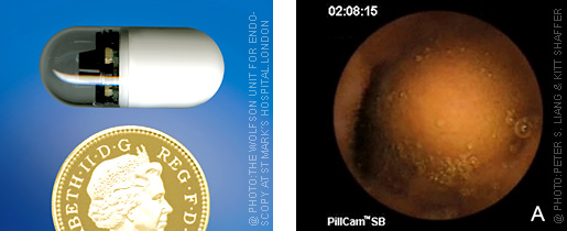 Endoscopy capsule and cancer